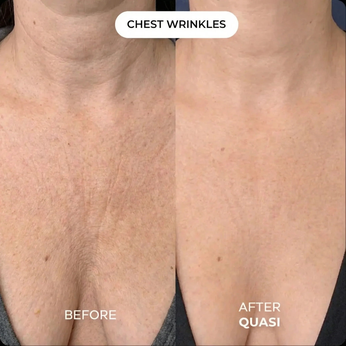 GHK-Cu Chest Mask